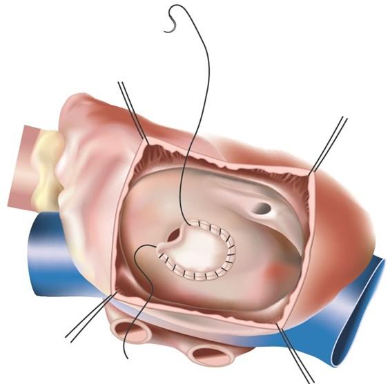 VSD closer